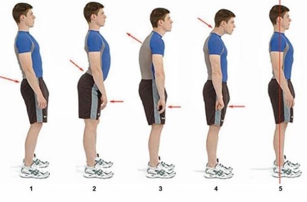hernia